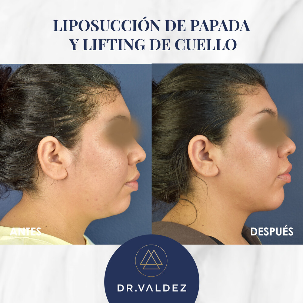 Before and After Result